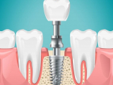 TẠI SAO MẤT RĂNG PHẢI CẮM TRỤ IMPLANT?