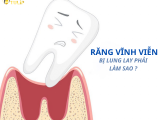 RĂNG VĨNH VIỄN BỊ LUNG LAY PHẢI LÀM SAO ?