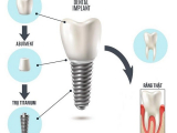 HEALING TRONG IMPLANT LÀ GÌ? VAI TRÒ CỦA HEALING TRONG IMPLANT