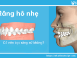 RĂNG HÔ BỌC SỨ HIỆU QUẢ KHÔNG?