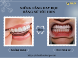 NIỀNG RĂNG HAY BỌC RĂNG SỨ TỐT HƠN