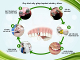 TÌM HIỂU VỀ QUY TRÌNH CẤY GHÉP IMPLANT