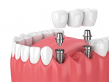IMPLANT BỊ ĐÀO THẢI: NGUYÊN NHÂN VÀ CÁCH KHẮC PHỤC