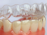 TÌM HIỂU VỀ NIỀNG RĂNG TRONG SUỐT INVISALIGN