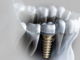 NHỮNG ĐIỀU CẦN CÂN NHẮC TRƯỚC KHI CẤY IMPLANT