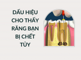 DẤU HIỆU CHO THẤY RĂNG BẠN BỊ CHẾT TỦY