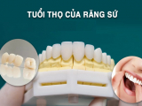BỌC RĂNG SỨ SỬ DỤNG ĐƯỢC BAO LÂU ?