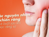 RĂNG BỊ Ê BUỐT SAU KHI BỌC RĂNG SỨ NGUYÊN NHÂN VÀ CÁCH KHẮC 