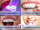 NHỮNG PHƯƠNG PHÁP TẨY TRẮNG RĂNG PHỔ BIẾN HIỆN NAY