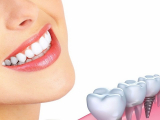 BẠN ĐÃ BIẾT NHỮNG LƯU Ý KHI TRỒNG RĂNG IMPLANT CHƯA?