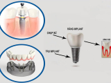 BỆNH TIỂU ĐƯỜNG CÓ TRỒNG RĂNG IMPLANT ĐƯỢC KHÔNG