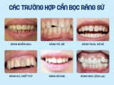 NHỮNG TRƯỜNG HỢP NÀO NÊN BỌC RĂNG SỨ