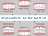 TOP 4 TRƯỜNG HỢP PHỔ BIẾN NÊN NIỀNG RĂNG 