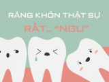 RĂNG KHÔN LÀ GÌ? CÓ NÊN NHỔ RĂNG KHÔN KHÔNG