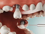 TRỒNG RĂNG IMPLANT LÀ GÌ? NHỮNG ĐIỀU CẦN BIẾT KHI CẤY IMPLANT