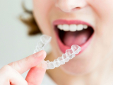 NHỮNG LƯU Ý KHI NIỀNG RĂNG TRONG SUỐT INVISALIGN