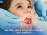 CÓ NÊN TRÁM RĂNG SỮA CHO BÉ HAY KHÔNG?