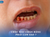 CHẢY MÁU CHÂN RĂNG PHẢI LÀM SAO ?