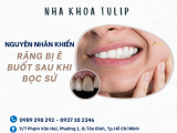 NGUYÊN NHÂN KHIẾN RĂNG BỊ Ê BUỐT SAU KHI BỌC SỨ