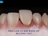 PHẢI LÀM GÌ KHI RĂNG SỨ BỊ LUNG LAY?