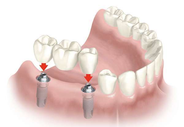 Kết hợp làm cầu răng sứ và cắm implant có được không? - Nha khoa  Nacerathisach.vn