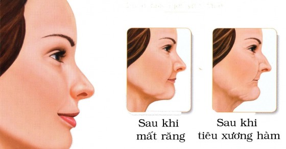 Tác hại khi mất nhiều răng hàm lâu năm và cách chữa trị | Dr. Care