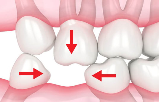 MẤT RĂNG HÀM LÂU NĂM LIỆU CÓ CẤY GHÉP ĐƯỢC IMPLANT?