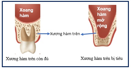 Kỹ thuật nâng xoang trong cấy ghép implant là gì? Kỹ thuật nâng xoang mới  nhất.