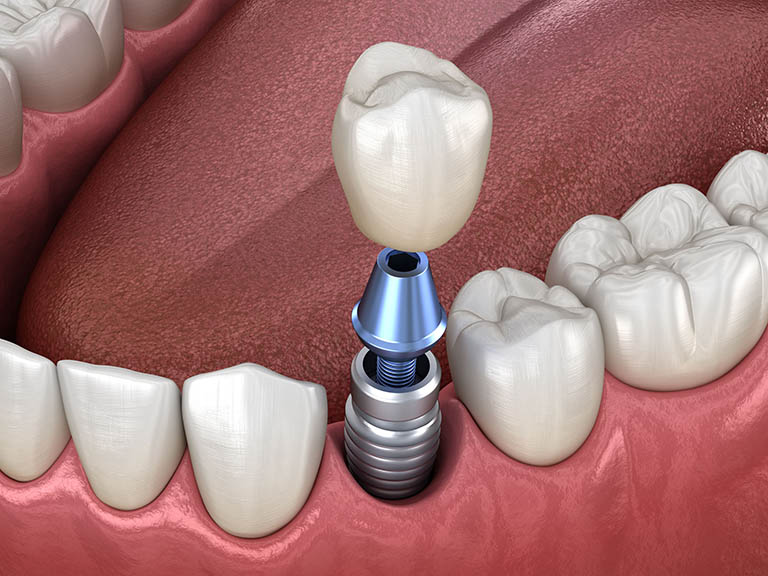 Cấy ghép implant sau bao lâu có thể lắp cầu răng sứ? Nha khoa Thùy Anh -  nhakhoathuyanh