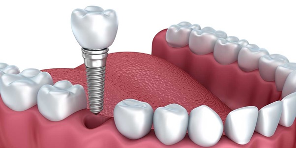 Những điều cần biết khi trồng răng implant