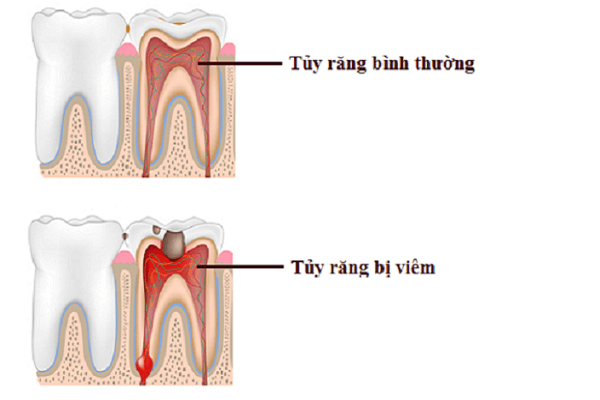 Viêm tủy răng: Khi nào cần điều trị? | Vinmec