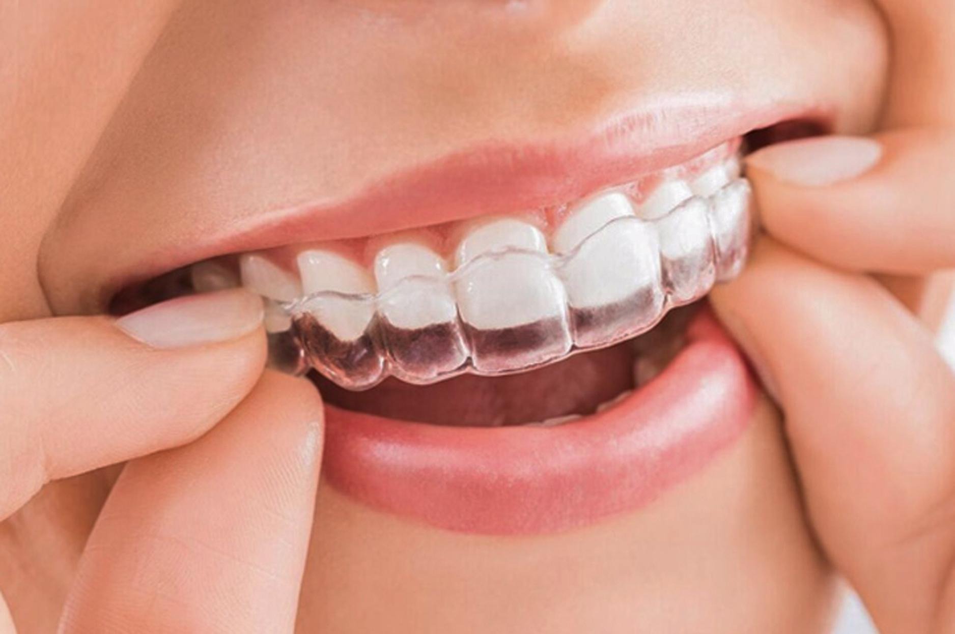 Niềng răng trong suốt invisalign nên hay không nên?