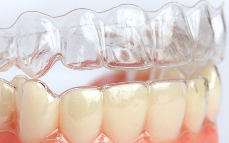 Niềng Răng Vô Hình Clear Aligner? Ưu Nhược Điểm, Đối Tượng Sử Dụng