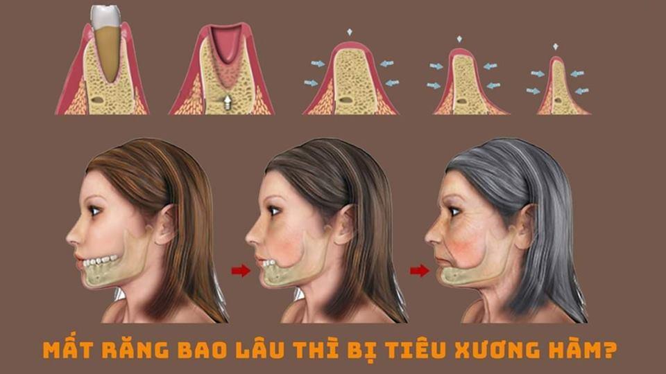 Nhổ răng bao lâu thì bị tiêu xương hàm? Nha khoa Thùy Anh - nhakhoathuyanh