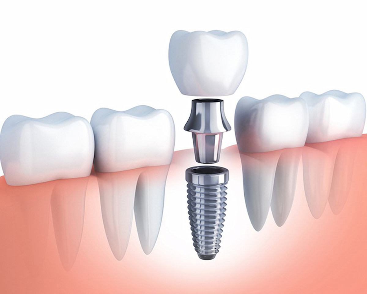 Cấy implant có đau không? 5 điều bạn nên biết khi cấy ghép Implant