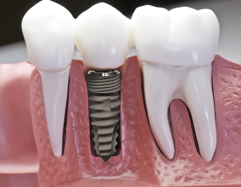 Lưu ý khi trồng răng Implant cho người bệnh nhân tiểu đường