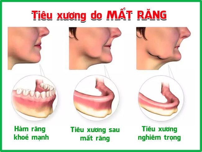 HẬU QUẢ NGHIÊM TRỌNG CỦA VIỆC MẤT RĂNG - Nha Khoa Việt Đức