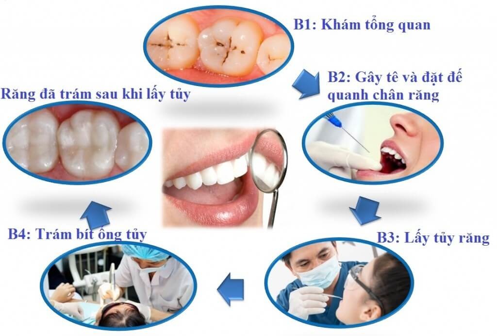 Quy trình lấy tủy răng nhanh chóng, an toàn, hiện đại