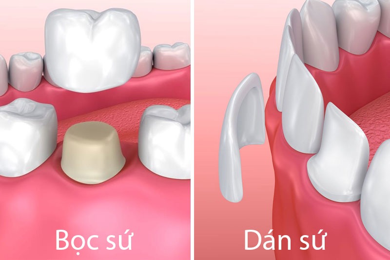 Bọc răng sứ và dán sứ veneer nên lựa chọn như thế nào?