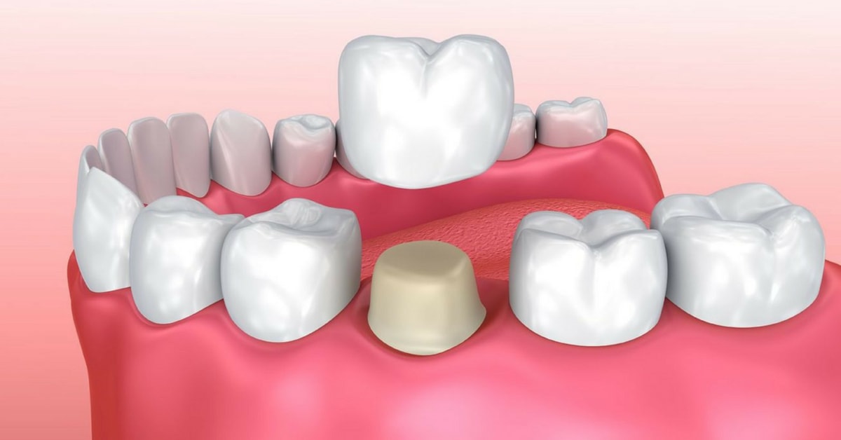 GIẢI ĐÁP THẮC MẮC] - Mất răng có bọc sứ được không? | Dr. Care