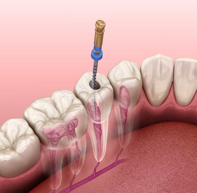 Lấy tủy răng có ảnh hưởng đến sức khỏe răng miệng không?