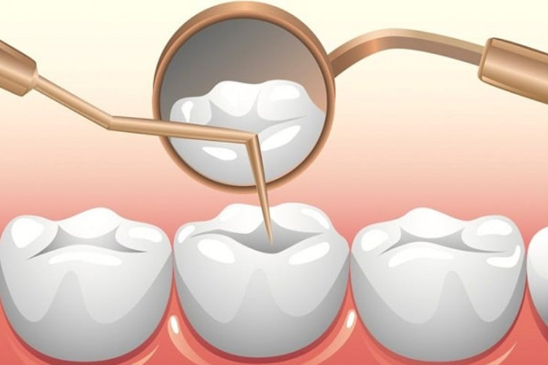 Hỏi đáp: Trám răng có phải lấy tủy không? Nha khoa Thùy Anh - nhakhoathuyanh