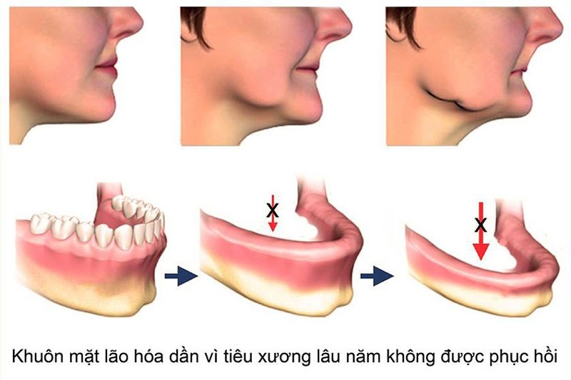 Tiêu xương hàm là gì? Tiêu xương hàm có nguy hiểm không?