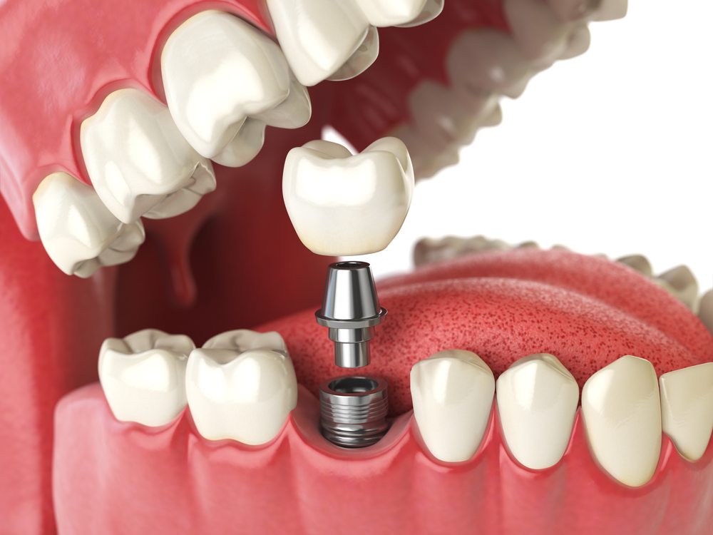 Cấy ghép implant | Nha khoa Stone