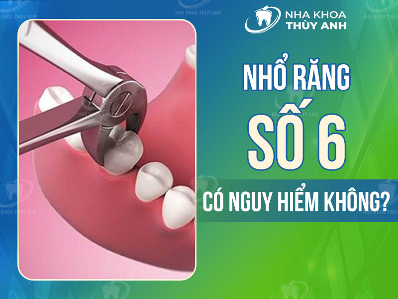 Nhổ răng số 6 có nguy hiểm không? Có phải trồng lại không? - nhakhoathuyanh