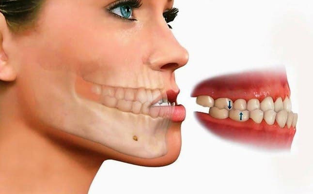 Răng móm ? 5 ảnh hưởng của răng móm - Be Dental