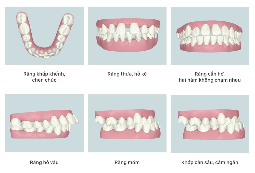 Chỉnh nha và những phương pháp chỉnh nha phổ biến | Zenyum VN