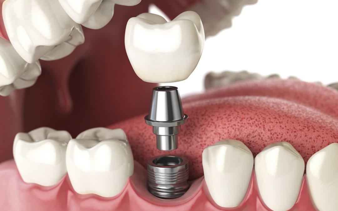 Những lợi ích khi cấy ghép Implant mà bạn chưa biết