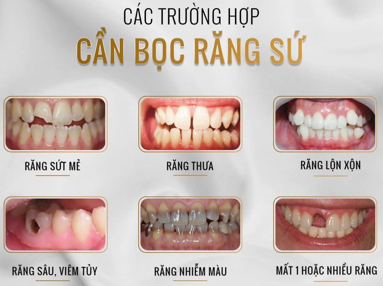 Khi Nào Nên Bọc Răng Sứ? Liệu Trường Hợp Của Em Có Nên Bọc Răng Sứ?