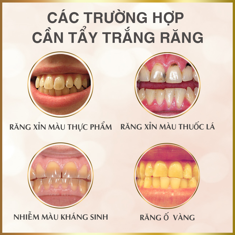 Tẩy Trắng Răng Có An Toàn Không? - Phòng Khám Nha Khoa Thu Trang